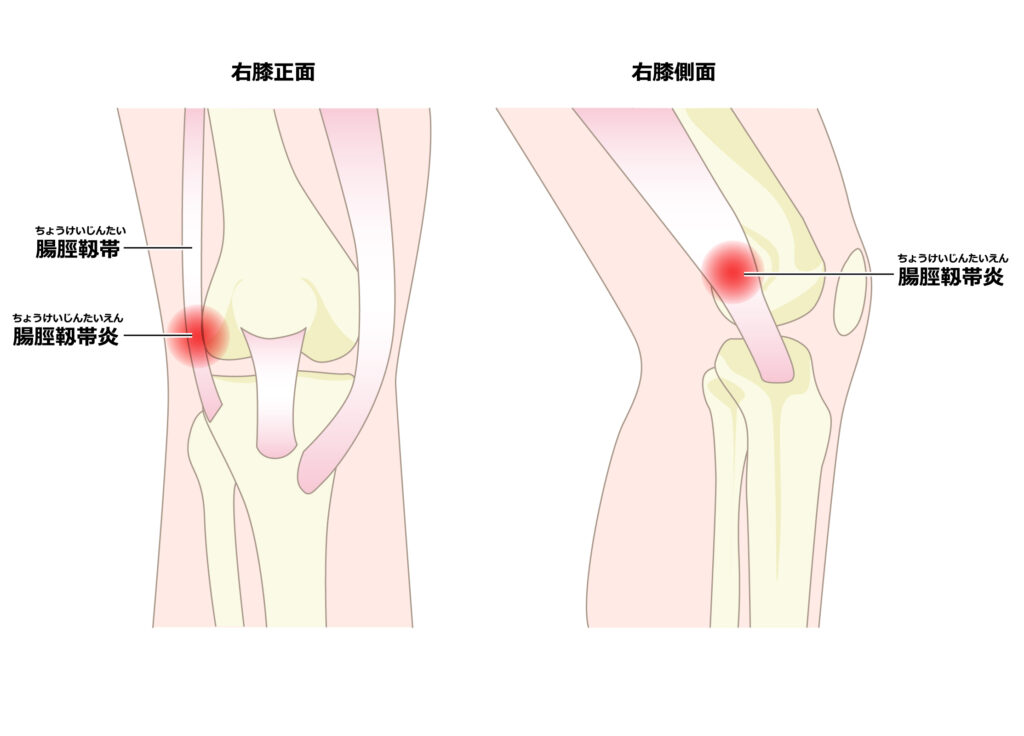 腸脛靭帯炎