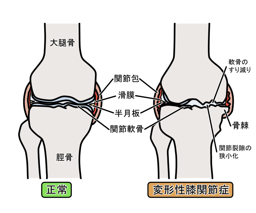 変形性膝関節症