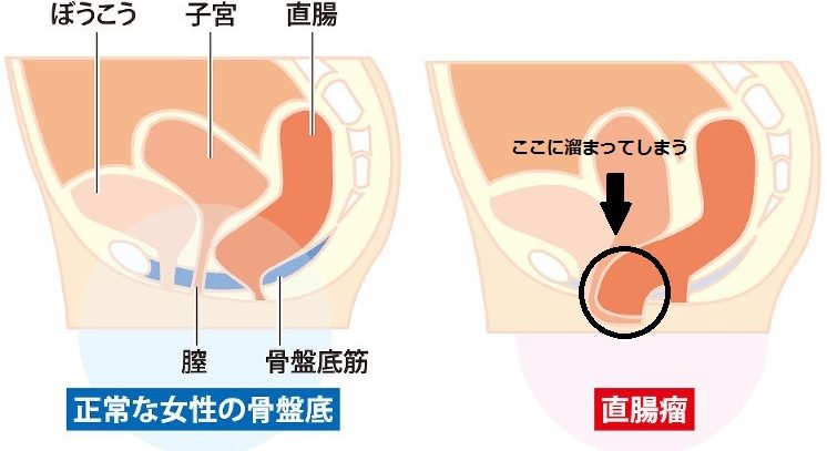 妊婦 便秘 いきむ