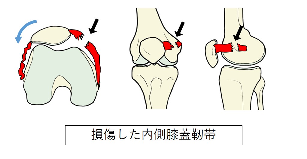 内側膝蓋靭帯損傷