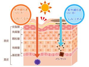 紫外線によるたるみ